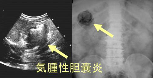 気腫性胆嚢炎 気腫性胆嚢炎