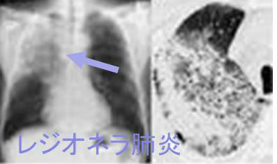 レジオネラ肺炎 レジオネラ肺炎