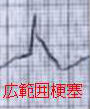 糖尿病の広範囲梗塞 糖尿病の広範囲梗塞