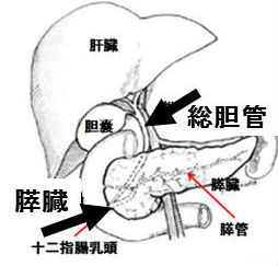 膵体尾部癌 膵体尾部癌
