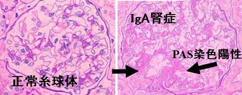 IgA腎症と甲状腺 IgA腎症と甲状腺
