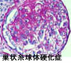 巣状糸球体硬化症(巣状分節性糸球体硬化症;FSGS) 巣状糸球体硬化症(巣状分節性糸球体硬化症;FSGS)