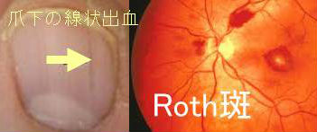 爪下の線状出血・眼底点状出血(Roth斑) 爪下の線状出血・眼底点状出血(Roth斑)