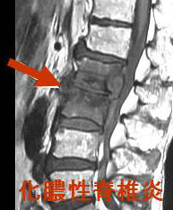 化膿性脊椎炎 化膿性脊椎炎