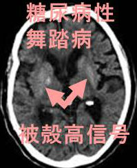 糖尿病性舞踏病 糖尿病性舞踏病