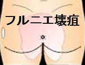 フルニエ壊疽(Fournier壊疽) フルニエ壊疽(Fournier壊疽)
