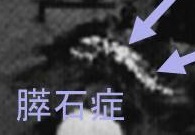 膵石症 CT画像 膵石症 CT画像