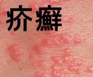 疥癬 疥癬