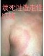 グルカゴノーマ 壊死性遊走性紅斑 グルカゴノーマ 壊死性遊走性紅斑