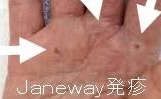 Janeway発疹 Janeway発疹