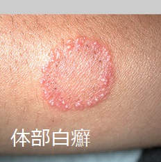 体部白癬 体部白癬
