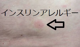 インスリンアレルギー インスリンアレルギー