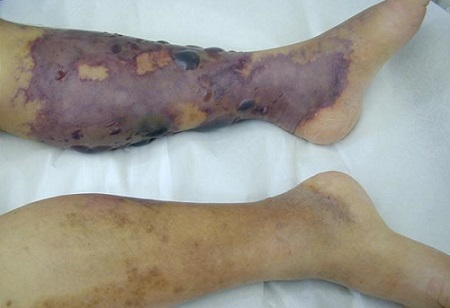 ビブリオ・バルニフィカスによる壊死性筋膜炎 ビブリオ・バルニフィカスによる壊死性筋膜炎