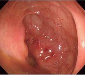 アメーバ性腸炎 アメーバ性腸炎