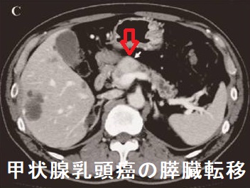 甲状腺乳頭癌の膵臓転移 甲状腺乳頭癌の膵臓転移