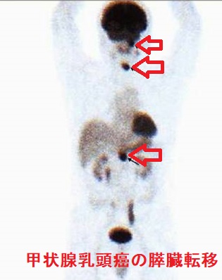 甲状腺乳頭癌の膵臓転移 PET-FDG 甲状腺乳頭癌の膵臓転移 PET-FDG