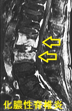化膿性脊椎炎 造影MRI T1脂肪抑制画像 化膿性脊椎炎 造影MRI T1脂肪抑制画像