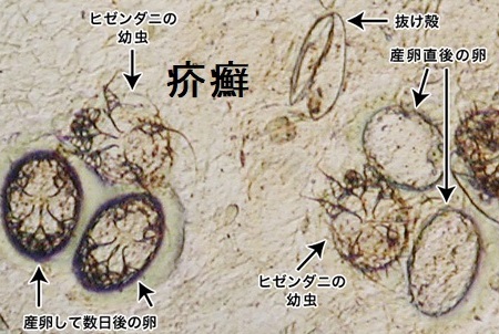 疥癬(鏡検) 疥癬(鏡検)