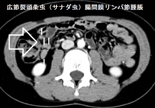 広節裂頭条虫(サナダ虫)腸間膜リンパ節腫脹 広節裂頭条虫(サナダ虫)腸間膜リンパ節腫脹