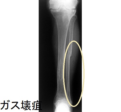 ガス壊疽 単純X線写真 ガス壊疽 単純X線写真