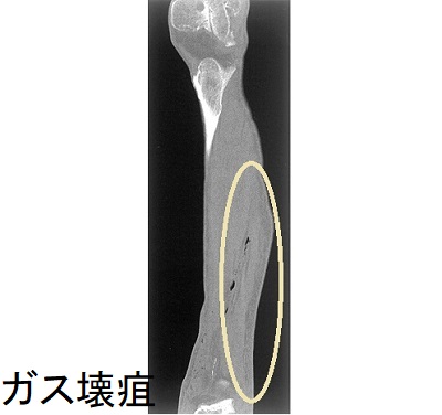 ガス壊疽 単純CT画像 ガス壊疽 単純CT画像