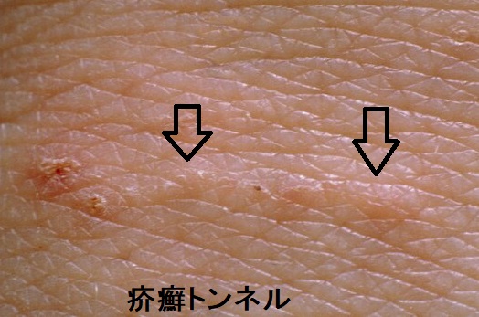 疥癬トンネル 疥癬トンネル