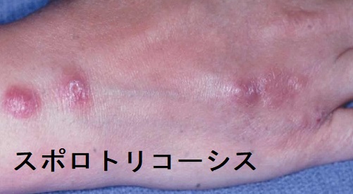 スポロトリコーシス 手 スポロトリコーシス 手