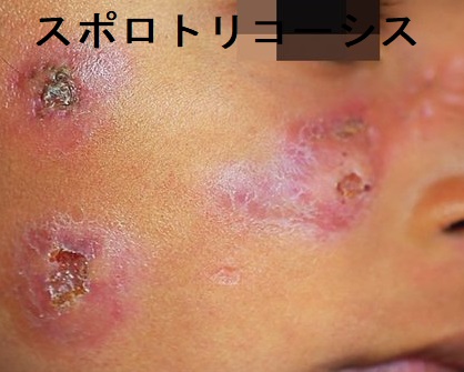スポロトリコーシス スポロトリコーシス