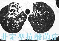 非定型抗酸菌症 CT画像 非定型抗酸菌症 CT画像