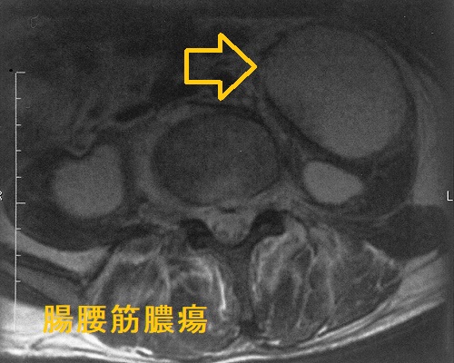 腸腰筋膿瘍 腰椎MRI T2強調画像 腸腰筋膿瘍 腰椎MRI T2強調画像