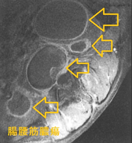 腸腰筋膿瘍 腰椎造影MRI画像 腸腰筋膿瘍 腰椎造影MRI画像