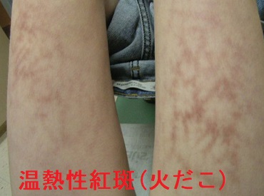 温熱性紅斑(火だこ) 温熱性紅斑(火だこ)
