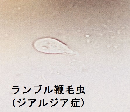 ランブル鞭毛虫 (ジアルジア症) ランブル鞭毛虫 (ジアルジア症)