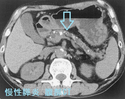 慢性膵炎 腹部CT 慢性膵炎 腹部CT