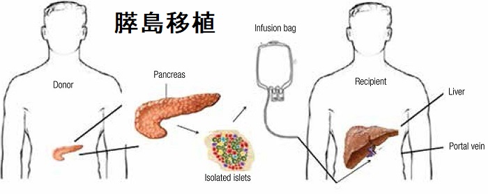 膵島移植 膵島移植