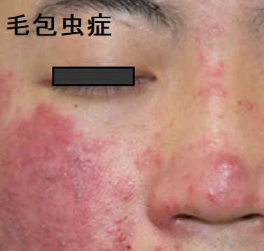 毛包虫症 毛包虫症