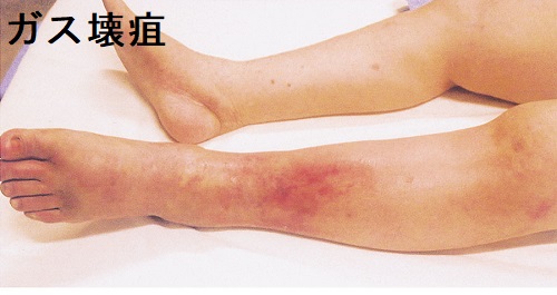 糖尿病ガス壊疽 糖尿病ガス壊疽