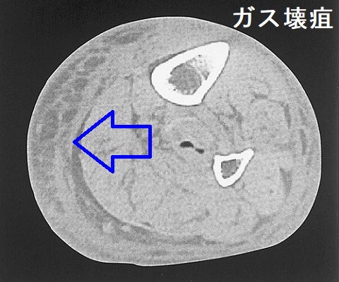 糖尿病ガス壊疽 糖尿病ガス壊疽