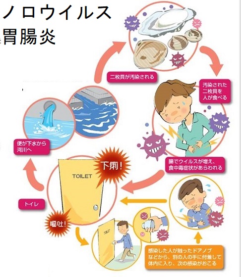ノロウイルス胃腸炎 ノロウイルス胃腸炎