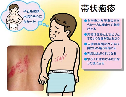 帯状疱疹 帯状疱疹