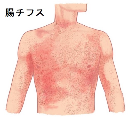 腸チフス 腸チフス