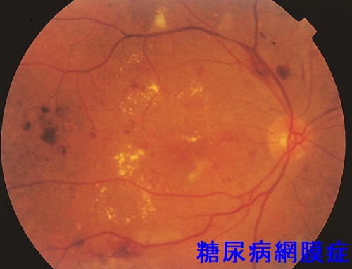 糖尿病性網膜症の眼底写真 糖尿病性網膜症の眼底写真