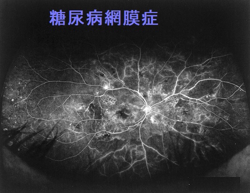 糖尿病性網膜症のフルオレセイン蛍光眼底造影検査 糖尿病性網膜症のフルオレセイン蛍光眼底造影検査