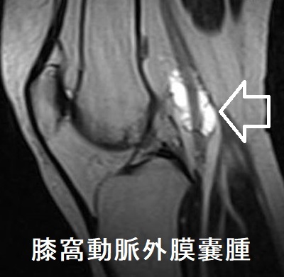 膝窩動脈外膜嚢腫 MRI T2WI画像 膝窩動脈外膜嚢腫 MRI T2WI画像