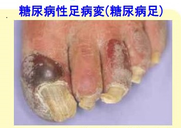 糖尿病性足病変(糖尿病足) 糖尿病性足病変(糖尿病足)