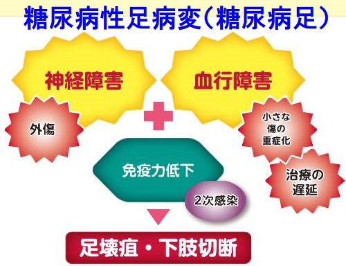 糖尿病性足病変(糖尿病足) 糖尿病性足病変(糖尿病足)