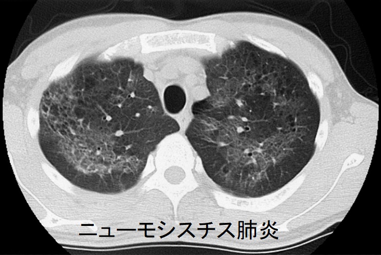 ニューモシスチス肺炎 肺CT画像 ニューモシスチス肺炎 肺CT画像