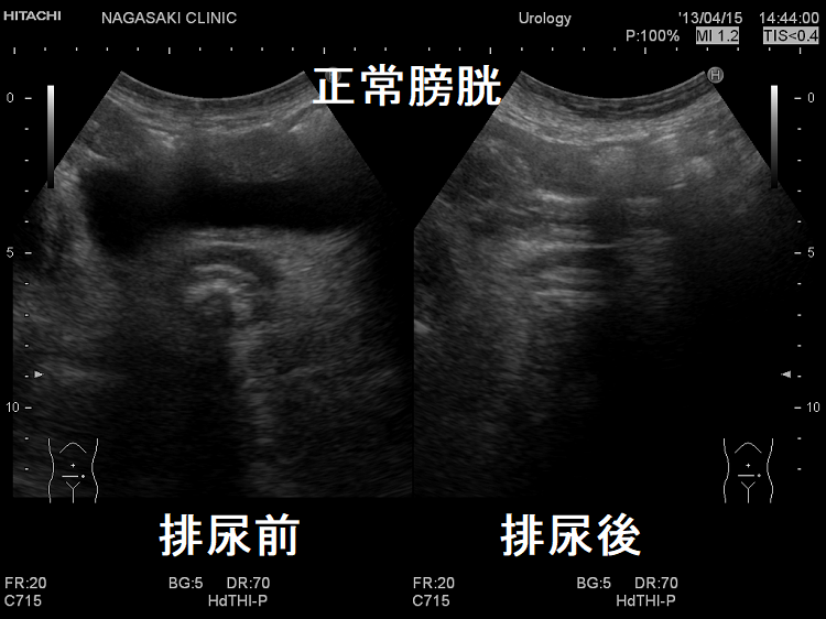 正常膀胱 正常膀胱