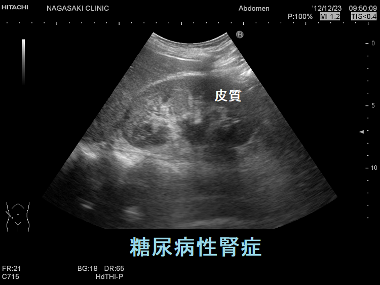 糖尿病性腎症 超音波(エコー)画像 糖尿病性腎症 超音波(エコー)画像