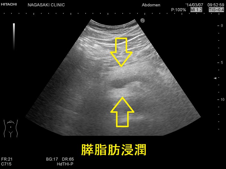 【超希少石】膵結石　超希少な膵結石　膵石　スイセキ　人体石標本資料 超希少石】膵結石 超希少な膵結石 膵石 スイセキ 人体石標本資料